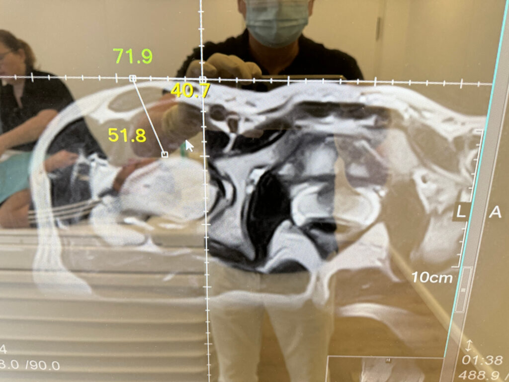 Arthrosamid 1