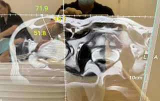 Arthrosamid 1