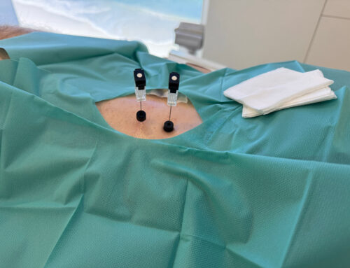 MRT‑gesteuerte PRT: Präzisionsmedizin gegen Nervenwurzelentzündungen